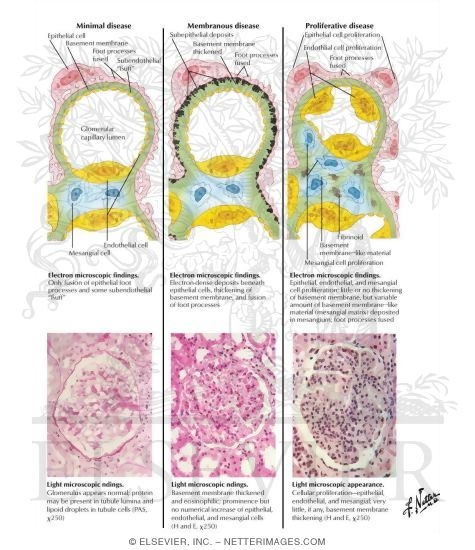 Watermarked preview of labeled image: Pathology of the Nephrotic Syndrome