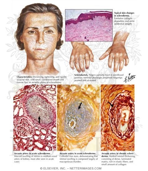 Progressive Systemic Sclerosis (Scleroderma) and Rheumatoid Arthritis