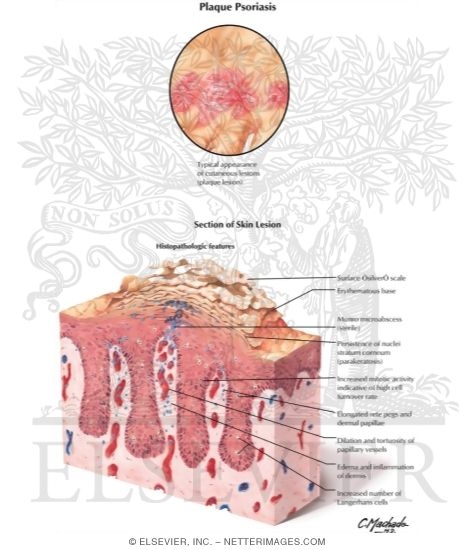 Plaque Psoriasis