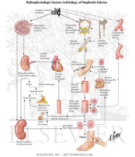 Pathophysiologic Factors in Etiology of Nephrotic Edema