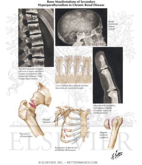Bone Manifestations of Secondary Hyperparathyroidism In Chronic Renal Disease