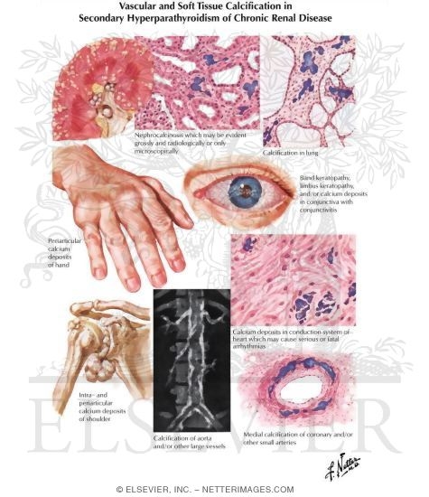 Vascular and Soft Tissue Calcification In Secondary Hyperparathyroidism of Chronic Renal Disease