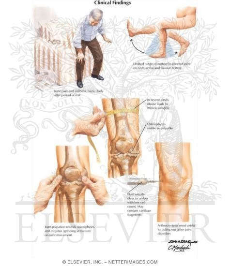 Clinical Findings In Osteoarthritis (OA)