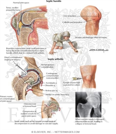 Septic Bursitis and Septic Arthritis