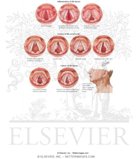 Hoarseness