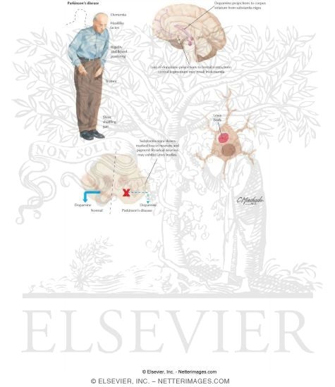 Extrapyramidal Disorders (Parkinson's Disease)