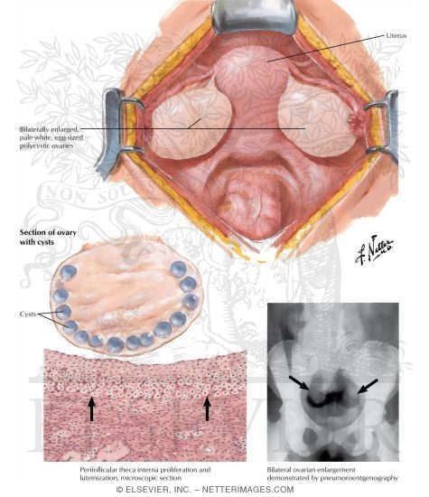 Endocrinopathies Associated With Ovarian Pathology II - Stein-Leventhal Syndrome