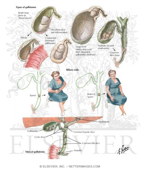 Cholelithiasis II: Clinical Aspects