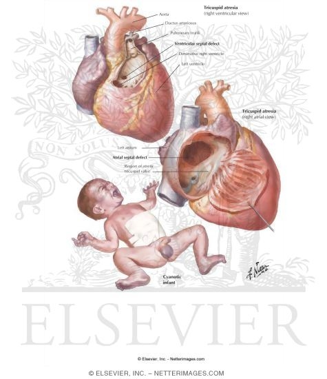 Anomalies of the Tricuspid Valve