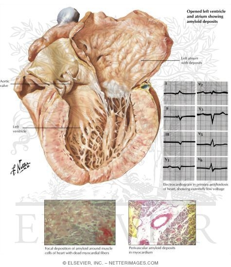 Amyloidosis
