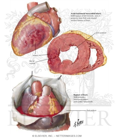 Arteriosclerotic Heart Disease