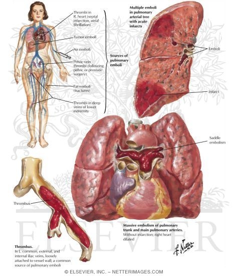 Acute Cor Pulmonale