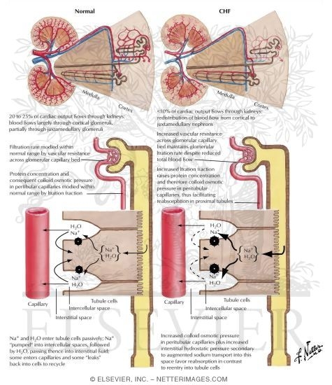 congestive heart failure stages images