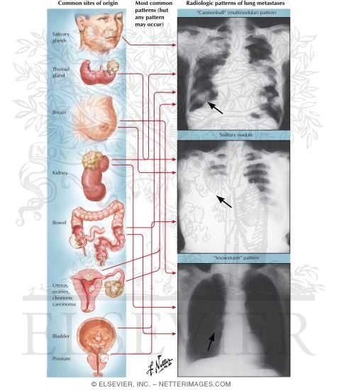 Metastatic Carcinoma to Lung
