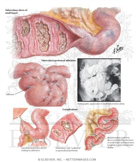 Intestinal Tuberculosis