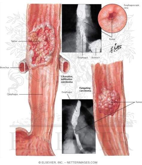 Malignant Tumors II - Midportion of Esophagus