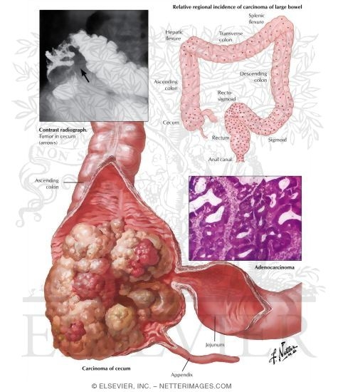 Malignant Tumors of Large Intestine