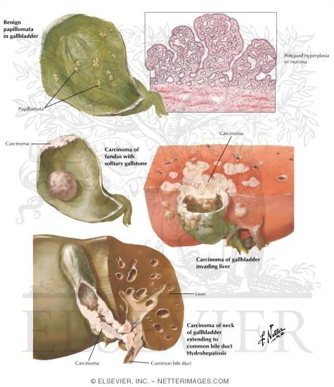 Tumors of Gallbladder