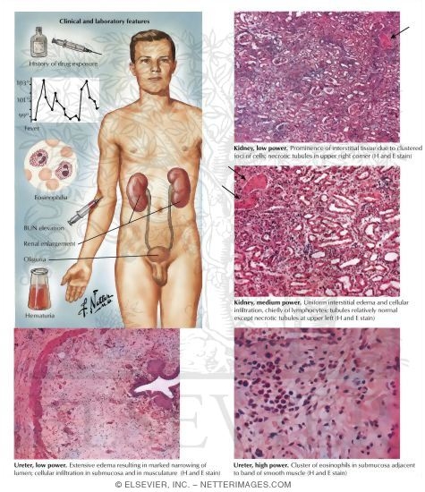 tubulointerstitial nephritis