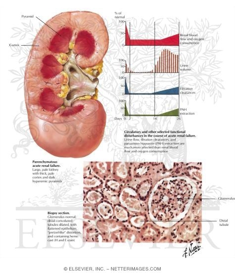 Acute Renal Failure