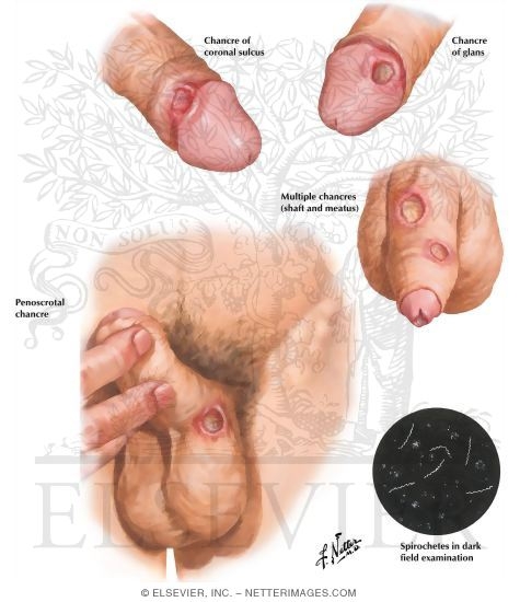 genital ulcer picture #10