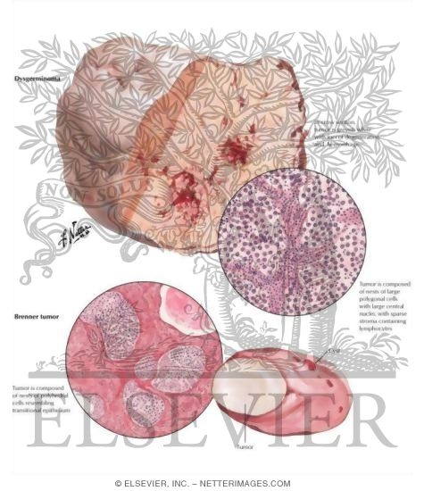 Dysgerminoma, Brenner Tumor