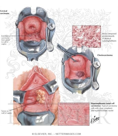 Malignant Tumors II - Metastases and Extension