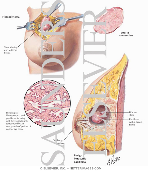Benign Fibro-adenoma, Intracystic Papilloma