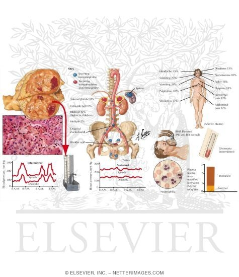 Chromaffin Tumors of the Adrenal Medulla