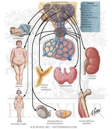 Manifestations of Suprasellar Disease