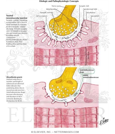 myasthenia gravis images. Myasthenia Gravis: Etiologic