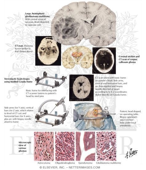 Gliomas