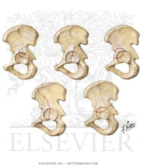 Pelvic Fractures