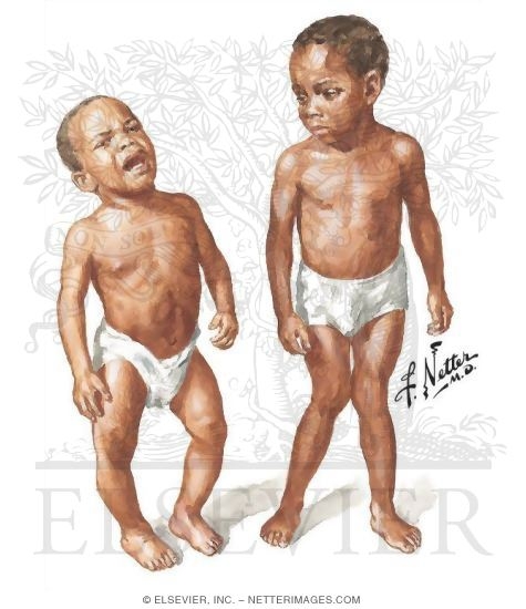 Genu valgum in adults treatments