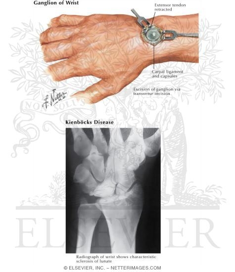 Ganglion of Wrist
Kienbock's Disease