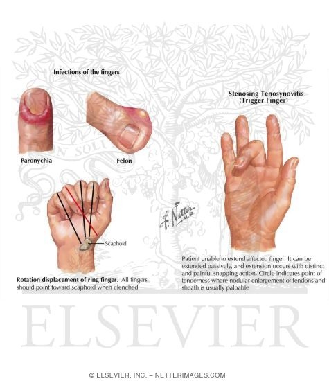 Infections of the Fingers