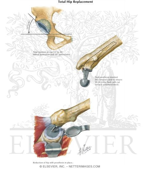 Tips on Total Hips