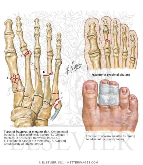 Fractures of the Foot