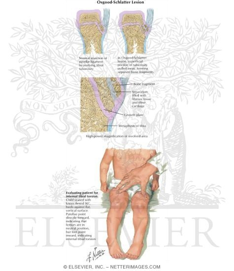 Pediatric Disorders of the Leg and Knee