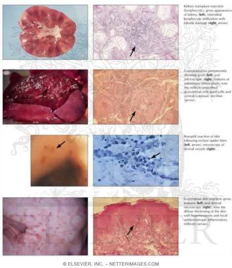 Immunologic Inflammation: T Cell