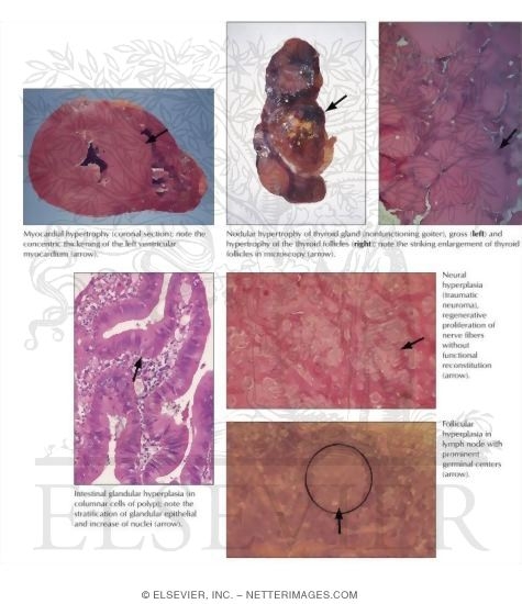 Hypertrophy and Hyperplasia