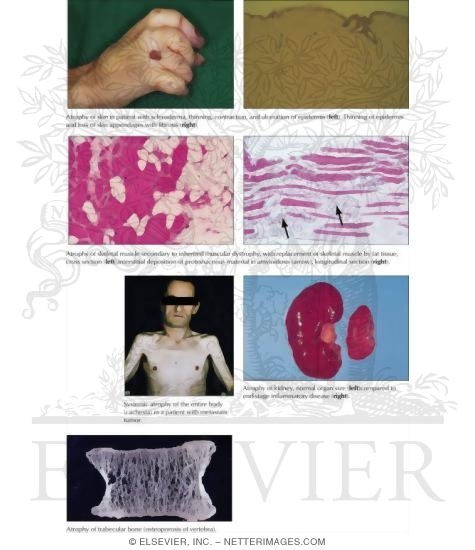 General Reaction Patterns: Atrophy