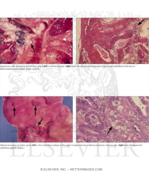 Malignant Tumors