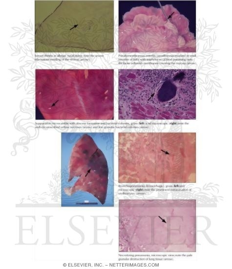 Acute Inflammation