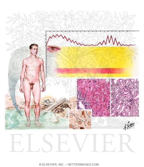 Weil Disease