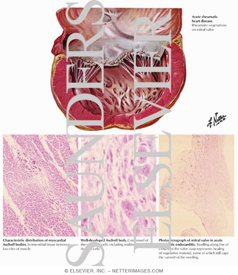 Rheumatic Heart Disease
