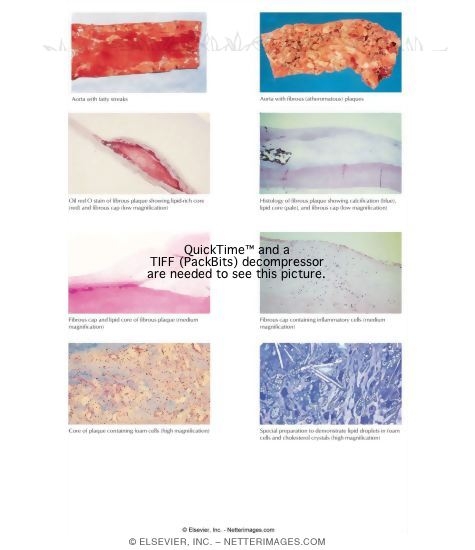 Atherosclerosis