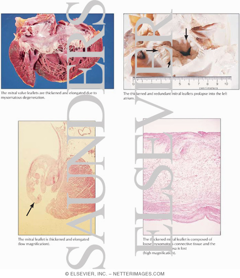 Mitral Valve Prolapse