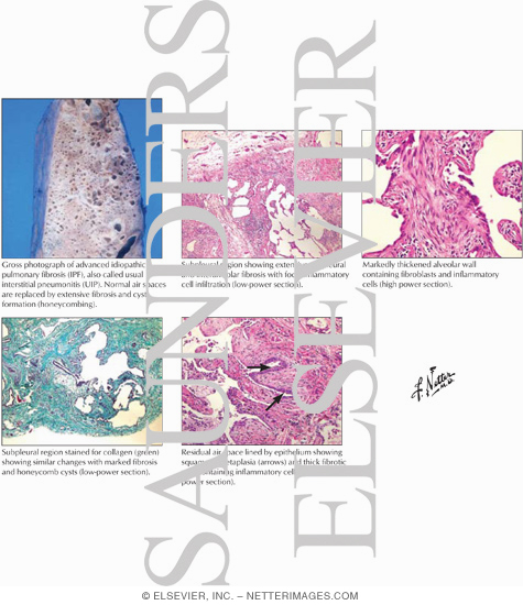 Idiopathic Pulmonary Fibrosis