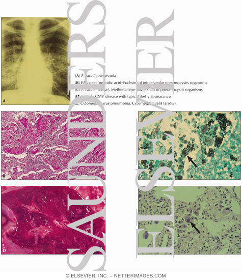 Opportunistic Pneumonias